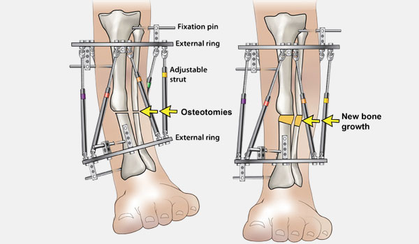 Arthroscopic Synovectomy treatment in Bangalore, Joint Infection Treatment, Pediatric Orthopedic Bangalore, Trauma Orthopedic Clinic, Orthopedic Rehabilitation, Bone Infection Care