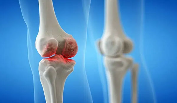 Arthroscopic Synovectomy treatment in Bangalore, Joint Infection Treatment, Pediatric Orthopedic Bangalore, Trauma Orthopedic Clinic, Orthopedic Rehabilitation, Bone Infection Care