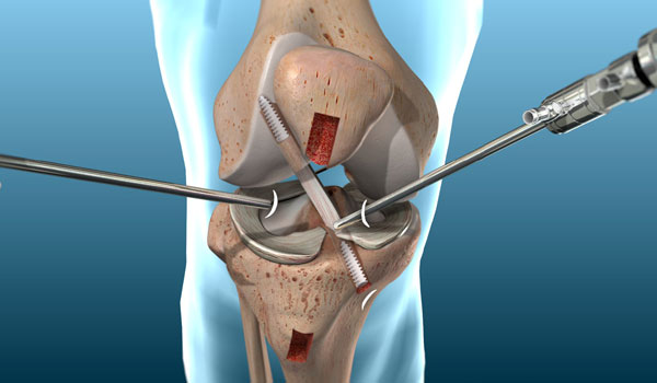 Knee Arthroscopy treatment in Bangalore, ACL Reconstruction Bangalore, PCL Repair near me, Meniscus Surgery KR Puram, Multiligament Reconstruction Segehalli,
