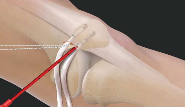 Knee Arthroscopy treatment in Bangalore, ACL Reconstruction Bangalore, PCL Repair near me, Meniscus Surgery KR Puram, Multiligament Reconstruction Segehalli,