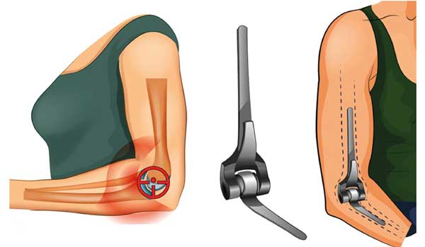 Joint Pain Treatment in Bangalore,Arthritis Specialist in Bangalore,Joint Pain Relief near KR Puram,Arthritis Doctor Seegehalli,Best Arthritis Treatment Bengaluru,Orthopedic Clinic for Joint Pain,Arthritis Clinic Mahadevapura,Joint Pain Management Bangalore,Joint Pain & Arthritis Doctor near me,Arthritis Treatment in Bangalore