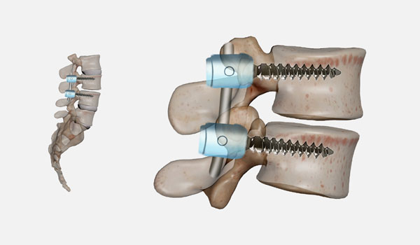 Back and Spine Care in Bangalore, Spine Specialist KR Puram, Slip Disc Treatment Segehalli, Sciatica Treatment Mahadevapura, Spine Injury Doctor Near Me,