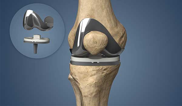 Joint Pain Treatment in Bangalore,Arthritis Specialist in Bangalore,Joint Pain Relief near KR Puram,Arthritis Doctor Seegehalli,Best Arthritis Treatment Bengaluru,Orthopedic Clinic for Joint Pain,Arthritis Clinic Mahadevapura,Joint Pain Management Bangalore,Joint Pain & Arthritis Doctor near me,Arthritis Treatment in Bangalore