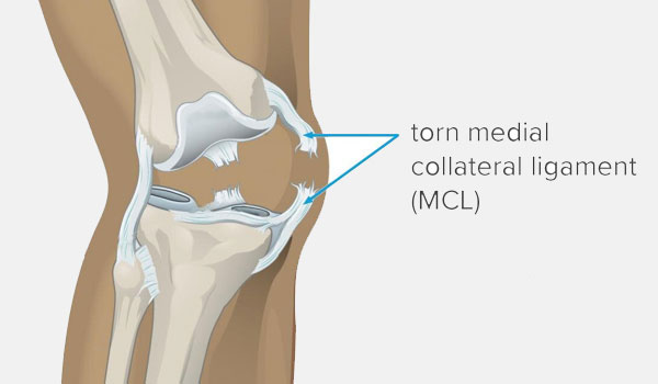 Knee Arthroscopy treatment in Bangalore, ACL Reconstruction Bangalore, PCL Repair near me, Meniscus Surgery KR Puram, Multiligament Reconstruction Segehalli,