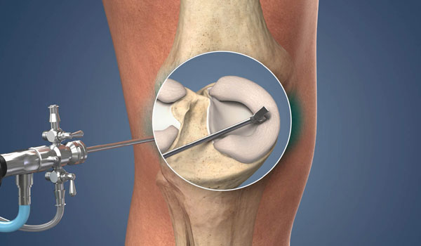 Knee Arthroscopy treatment in Bangalore, ACL Reconstruction Bangalore, PCL Repair near me, Meniscus Surgery KR Puram, Multiligament Reconstruction Segehalli,