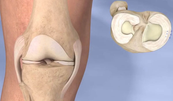 Knee Arthroscopy treatment in Bangalore, ACL Reconstruction Bangalore, PCL Repair near me, Meniscus Surgery KR Puram, Multiligament Reconstruction Segehalli,