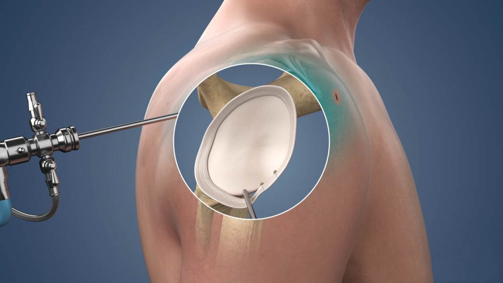 Arthroscopic Synovectomy treatment in Bangalore, Joint Infection Treatment, Pediatric Orthopedic Bangalore, Trauma Orthopedic Clinic, Orthopedic Rehabilitation, Bone Infection Care